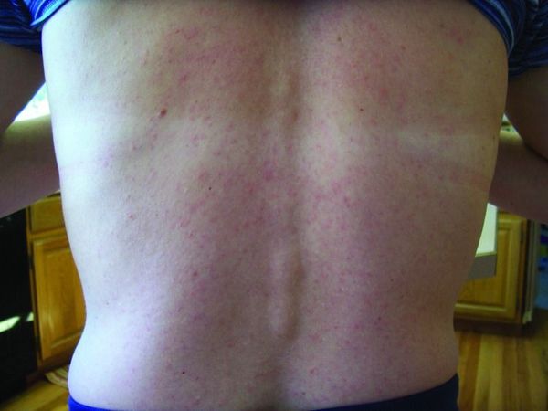 Osip karakterističan za Zika virus.